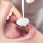 【進行度別】虫歯を治す治療方法の種類